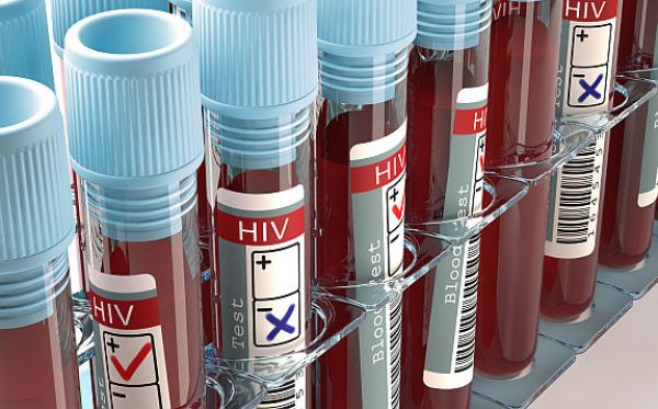 Spektrum patogenů u pacientů s terminálním stádiem AIDS se v průběhu let nemění